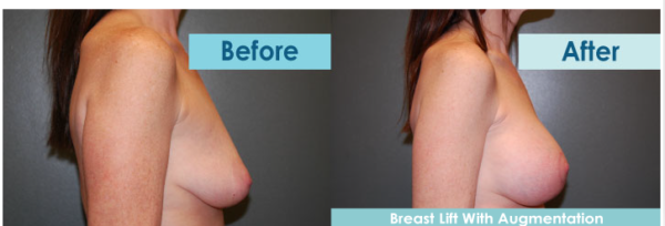 Breast Lift Surgery – Breast Uplift Surgery